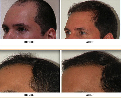 Demystifying Hair Loss Treatment (Jan 2013) Townsend Letter for Doctors &  Patients