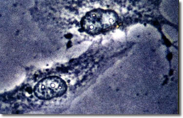 Cancerous Glioblastoma Cell